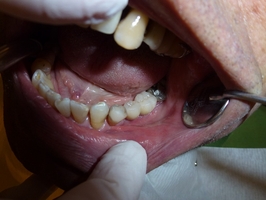 Голямо разнообразие Dental Implants 30