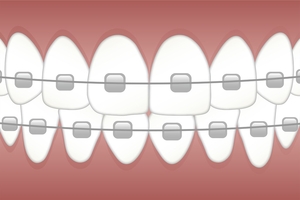 Типове Dental Implants 32